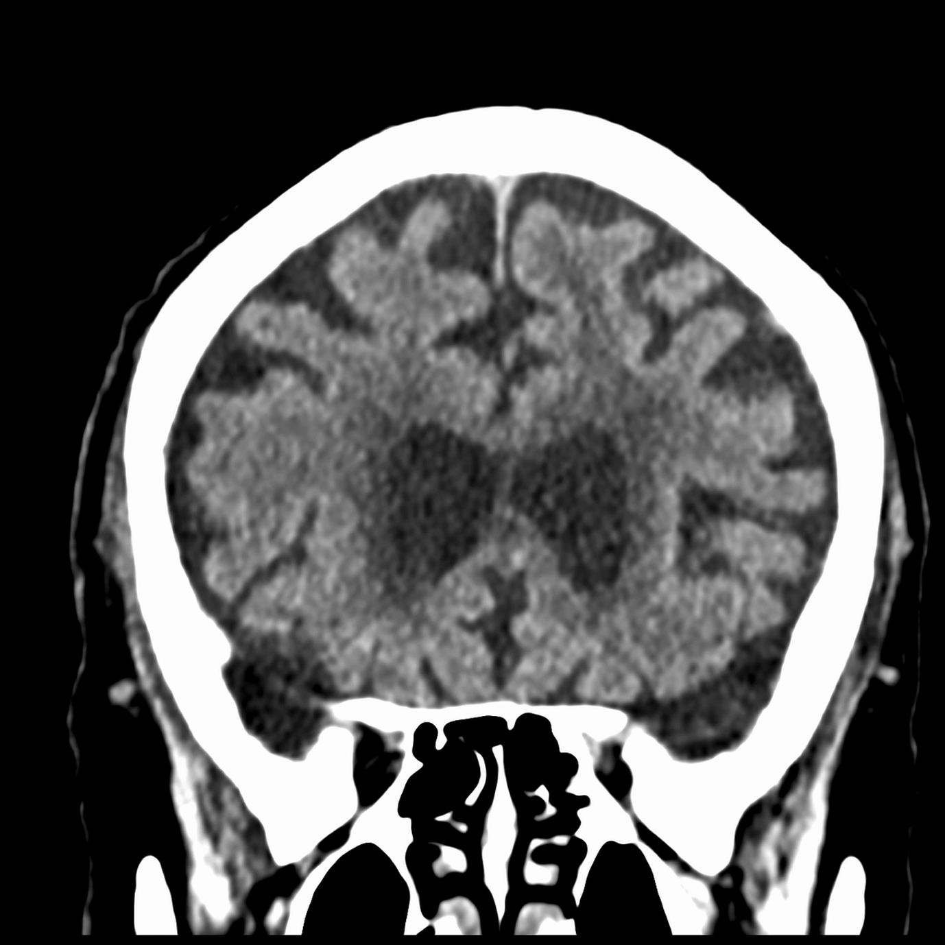 Tomografía de cráneo para evaluación neurológica