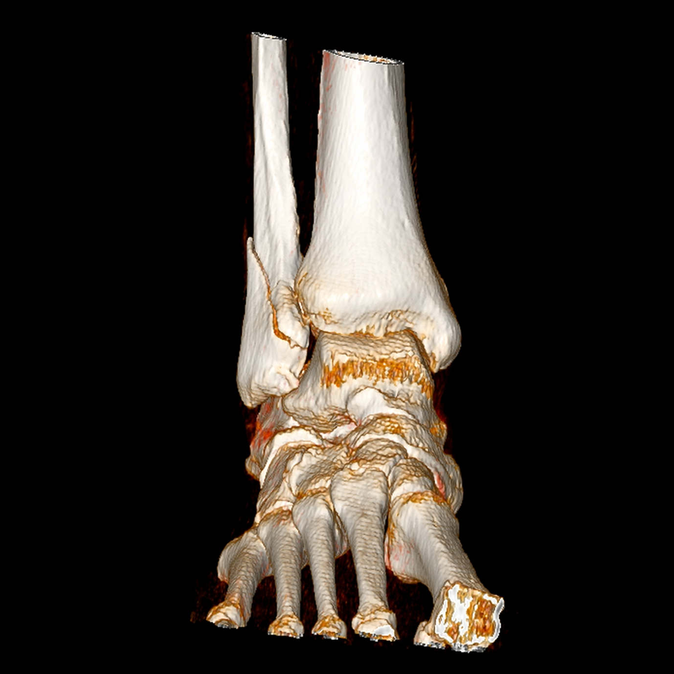 Tomografía de extremidades para evaluación ósea y articular