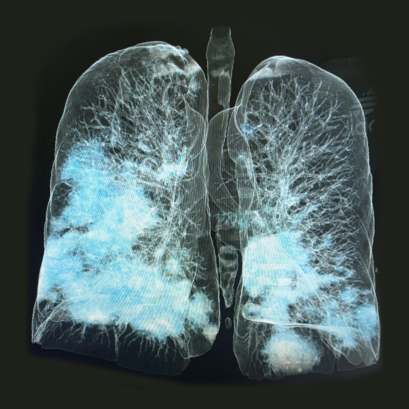 Tomografía de tórax para evaluación pulmonar y respiratoria